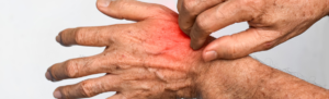Elderly person scratching irritated skin on hand